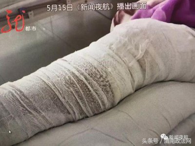 ​右腿手术左腿被开 涉事医院院长：不清楚医生怎么会犯这么低级的错误